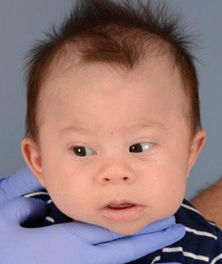 Dexter Osborne (DOB 5/20/2017) had metopic craniosynostosis and underwent strip craniectomy surgery using limited incision technique.