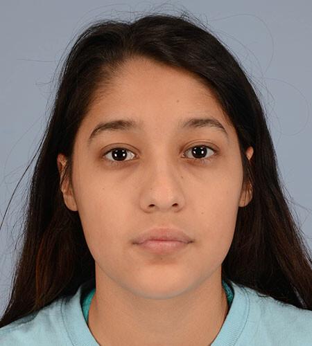 Christina Valenzuela (DOB 10/19/2000) nasal trauma before surgery. There are 5 additional images of different angles.