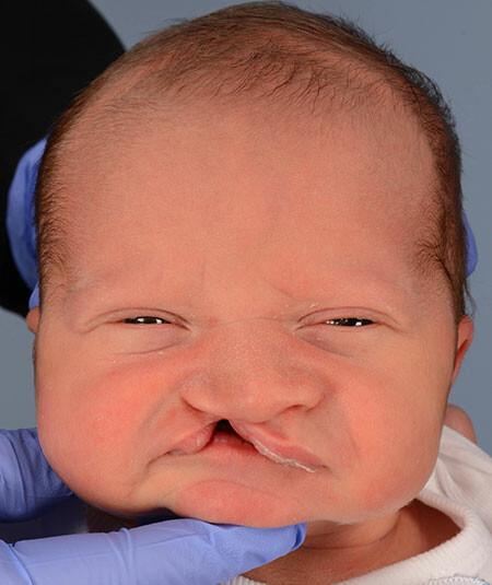 Crosby Adams, DOB 9/17/2016 Unilateral cleft lip before surgery. 2 additional images were used of different angles.