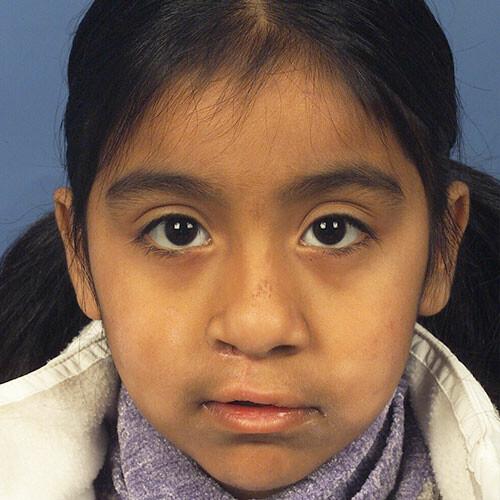 Daisy Rodriguez (DOB 9/3/1997) most recently underwent Lefort I maxillary osteotomy and advancement with Dr. Smartt. 3 additional photos are used at different angles.