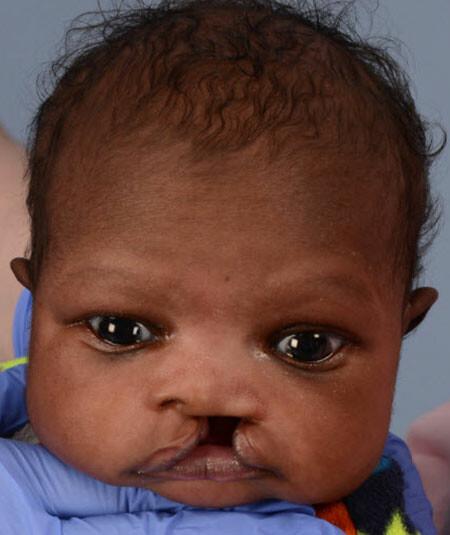 Unilateral Cleft lip and palate before surgery. Marib Mohamei DOB 1/11/2017