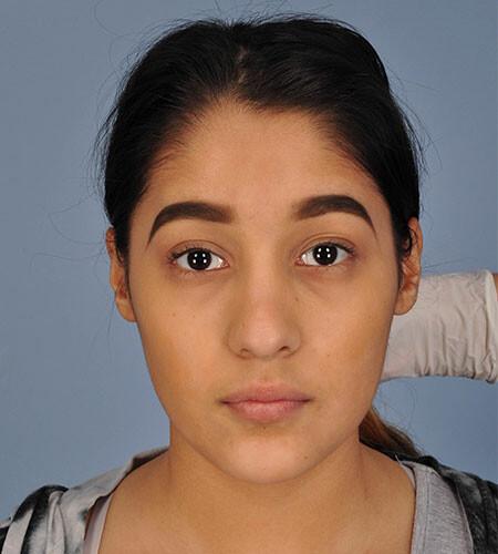 Christina Valenzuela (DOB 10/19/2000) nasal trauma after surgery. There are 5 additional images of different angles.