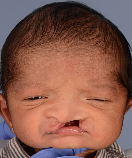 Yusuf Farooqi (DOB 3/10/2017) before Unilateral cleft lip and palate surgery. 4 additional photos are used from different angles.